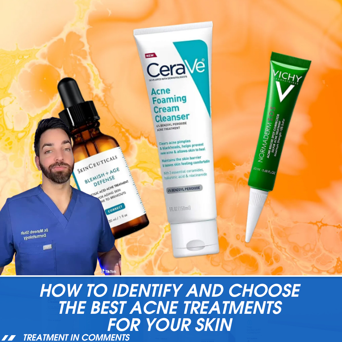 How to Identify and Choose the Best Acne Treatments For Your Skin