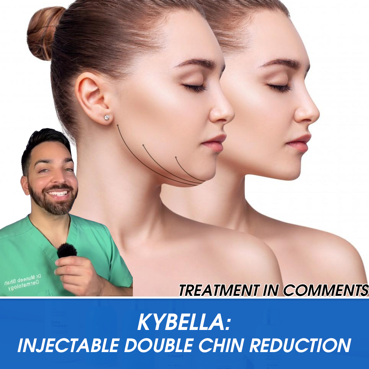 Kybella: Injectable Double Chin Reduction
