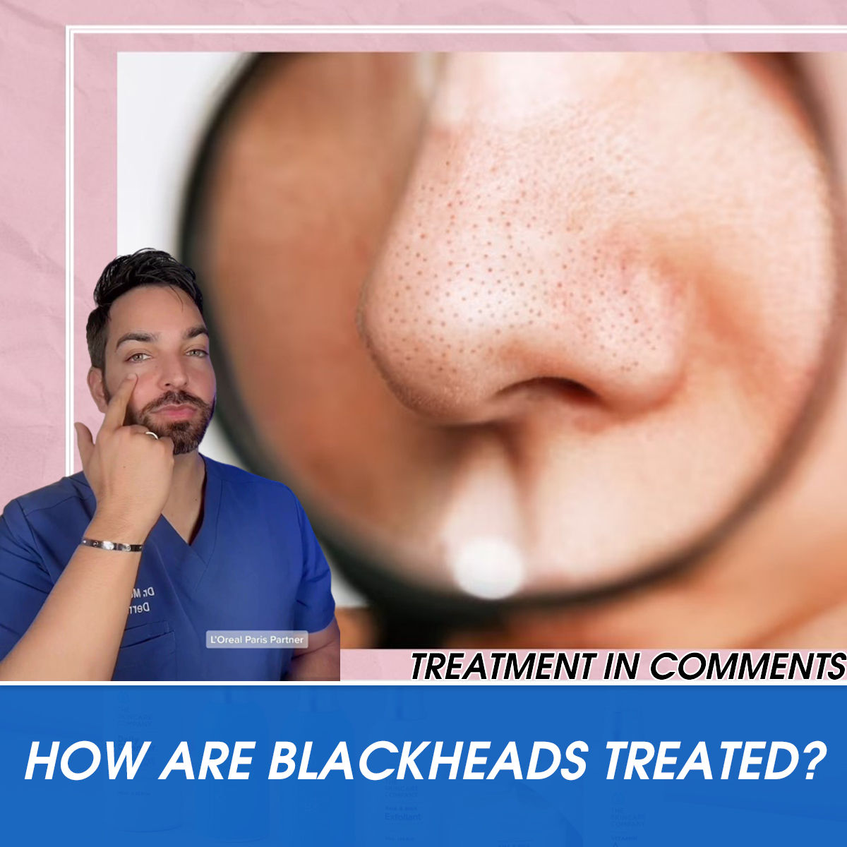 How Are Blackheads Treated?