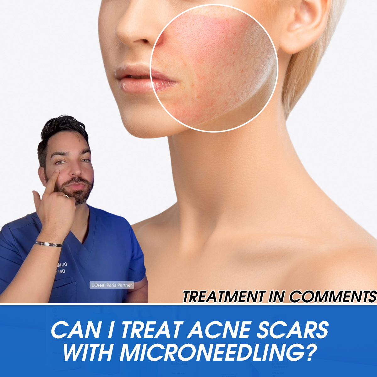 Can I Treat Acne Scars with Microneedling?