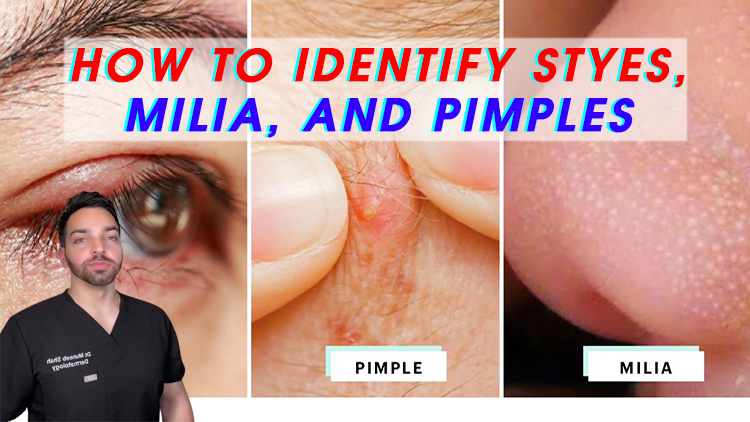 How to Identify Styes, Milia, and Pimples